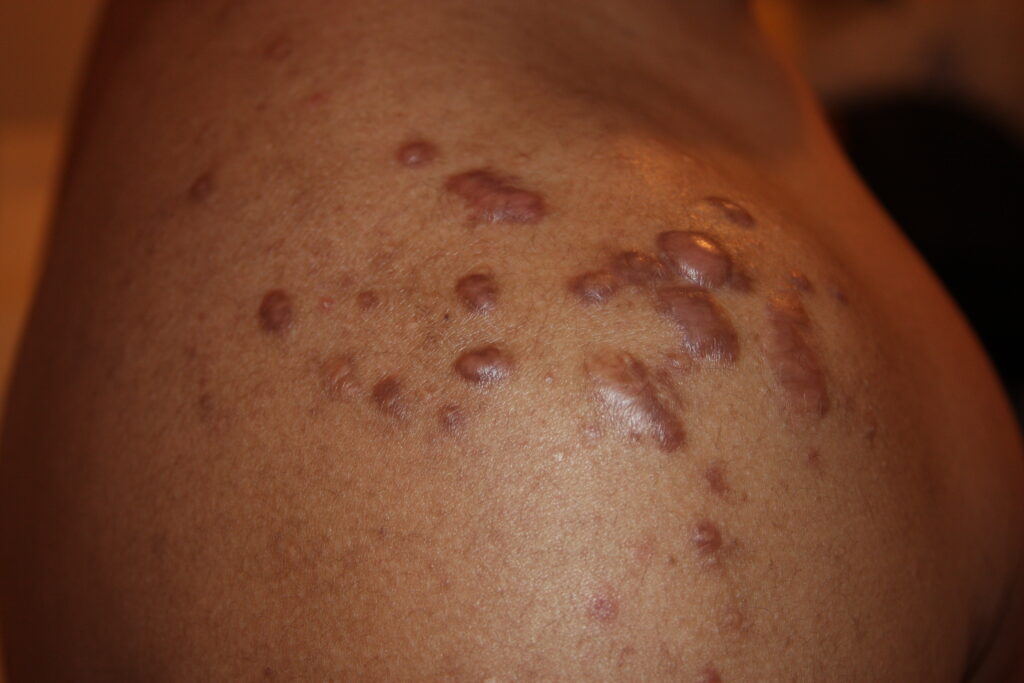 Keloid scars shoulder