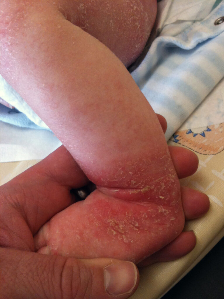 Atopic dermatitis child 2