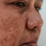 Melasma face