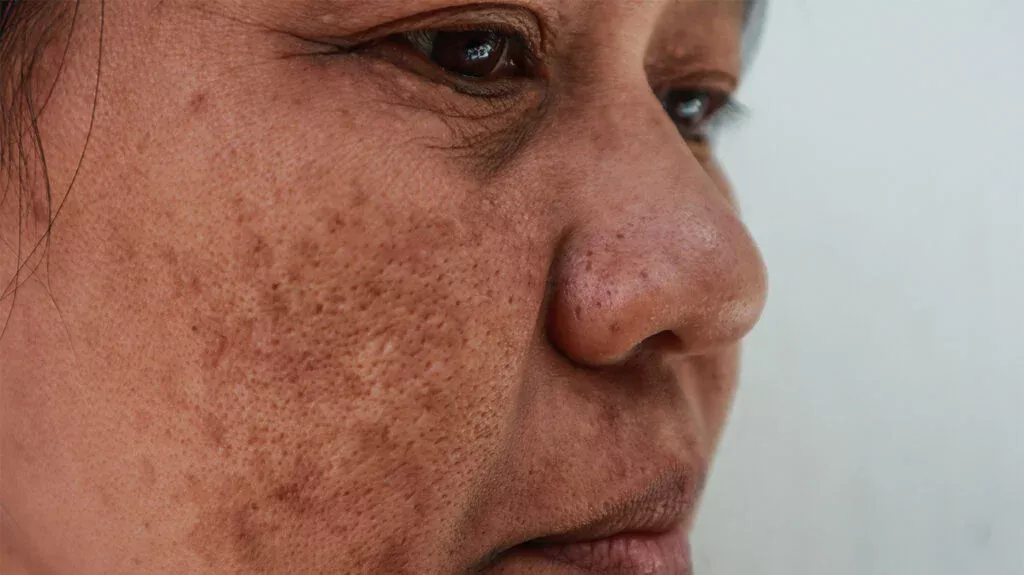 Melasma face